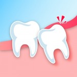 การผ่าฟันคุด