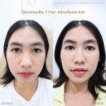 ฟิลเลอร์ อินทามาระ - คลินิกความสวยความงามรัชดา 17