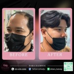วิกผมสำหรับคนหัวล้าน - ร้านวิกผมติดกาว ช่างองุ่น - Dara Hairwig