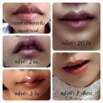 ศัลกรรมทำปากกระจับ - คลินิกศัลยกรรมตกแต่งเสริมสวย รังสิต