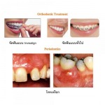 รักษาเหงือก เชียงใหม่ - โรงพยาบาลทันตกรรม เอเซีย ฟอร์จูน