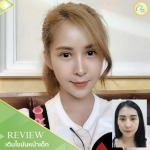 เติมไขมันหน้าเด็ก เชียงราย - คลินิกศัลยกรรม เชียงราย Chic Clinic