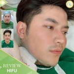 ทำ HIfu เชียงราย - คลินิกศัลยกรรม เชียงราย Chic Clinic