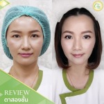 ทำตาสองชั้น เชียงราย - คลินิกศัลยกรรม เชียงราย Chic Clinic