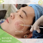 รักษาหลุมสิว เชียงราย - คลินิกศัลยกรรม เชียงราย Chic Clinic