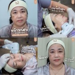 Hifu อินทามระ - คลินิกความสวยความงามรัชดา 17