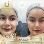 ฉีดโบลดกราม ชลบุรี
