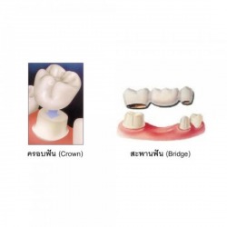 ทำสะพานฟัน เชียงใหม่
