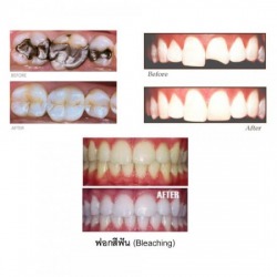 ฟอกสีฟัน เชียงใหม่