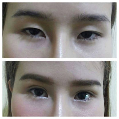 แก้ไขตาสองชั้น - คลินิกศัลยกรรมตกแต่งเสริมสวย รังสิต