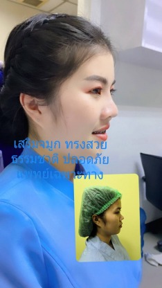 รีวิวเสริมจมูกหมอจำนงค์ - คลินิกศัลยกรรมตกแต่งเสริมสวย รังสิต