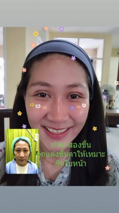 รีวิวทำตา2ชั้น รังสิต - คลินิกศัลยกรรมตกแต่งเสริมสวย รังสิต