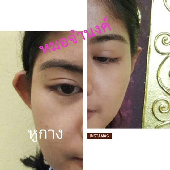 ศัลกรรมแก้ไขหูหาง ศัลกรรมแก้ไขหูหาง