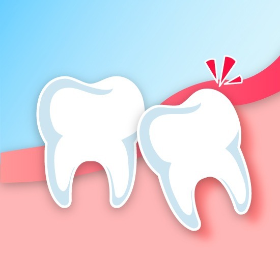คลินิกทันตกรรมเด็นทัลวิลลา - การผ่าฟันคุด