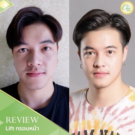 Lift กรอบหน้า เชียงราย