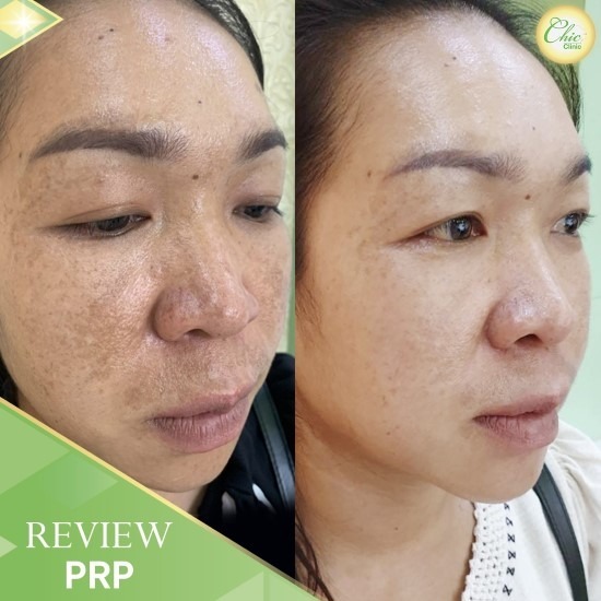 PRP เชียงราย PRP เชียงราย 