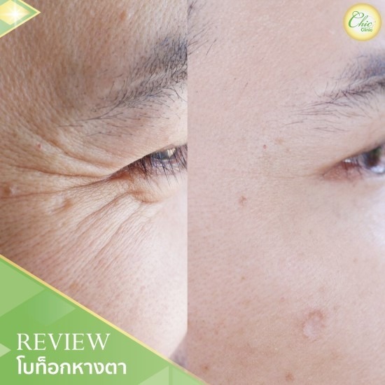 โบท็อกหางตา เชียงราย โบท็อกหางตา เชียงราย 