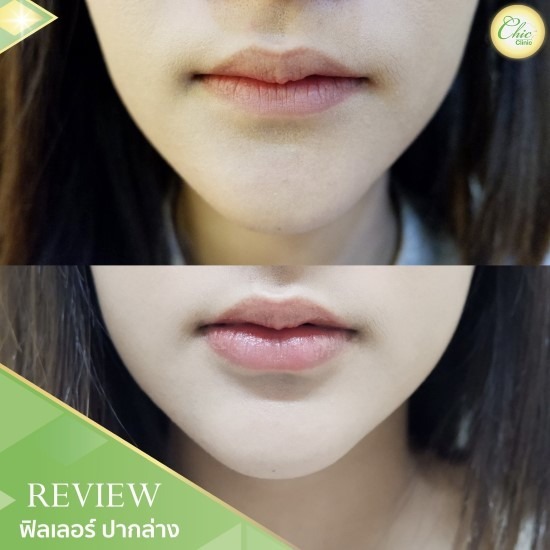 ฟิลเลอร์ ปากล่าง เชียงราย ฟิลเลอร์ ปากล่าง เชียงราย 