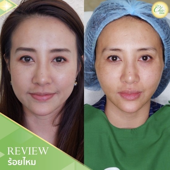 ร้อยไหม เชียงราย ร้อยไหม เชียงราย 