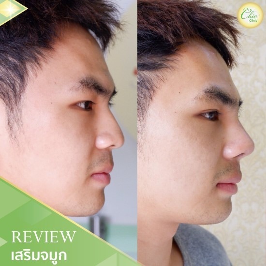 เสริมจมูก ผู้ชาย เสริมจมูก ผู้ชาย 