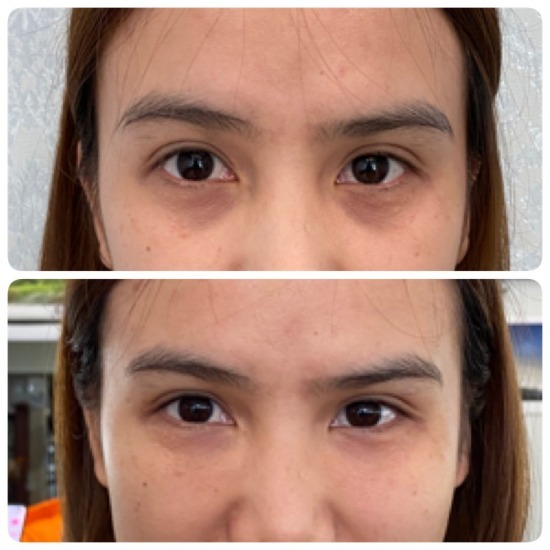 ฉีดฟิลเลอร์ใต้ตา เชียงราย ฟิลเลอร์ใต้ตา เชียงราย 