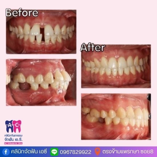 คลินิกจัดฟันใกล้ฉัน สมุทรปราการ คลินิกจัดฟันใกล้ฉัน สมุทรปราการ  คลินิกจัดฟันใกล้ฉัน  คลินิกทันตกรรมใกล้ฉัน  คลินิกจัดฟันใกล้ฉัน ราคาถูก  คลินิกจัดฟัน 