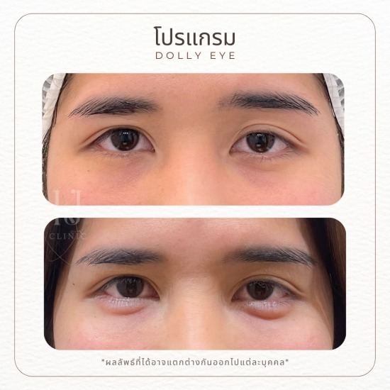 Dolly eye รัชดา ฉีดโบท็อกรัชดา  ฉีดโบท็อกอินทามระ  Botox ราคาถูก  โปรแกรมหน้าใส รัชดา  โปรแกรมหน้าใส อินทามระ  รักษาฝ้า รัชดา  รักษาฝ้า อินทามระ  รักษาสิว รัชดา  วิตามินผิว รัชดา  เสริมจมูก รัชดา 