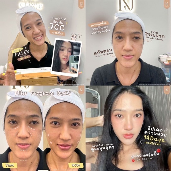 Filler รัชดา ฉีดโบท็อกรัชดา  ฉีดโบท็อกอินทามระ  Botox ราคาถูก  โปรแกรมหน้าใส รัชดา  โปรแกรมหน้าใส อินทามระ  รักษาฝ้า รัชดา  รักษาฝ้า อินทามระ  รักษาสิว รัชดา  วิตามินผิว รัชดา  เสริมจมูก รัชดา 