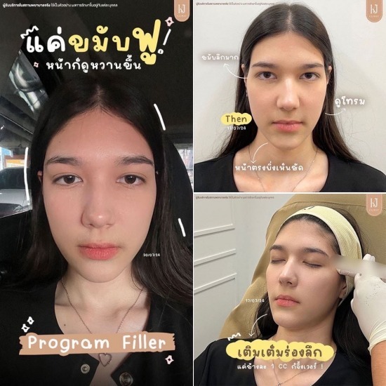 Filler อินทามระ ฉีดโบท็อกรัชดา  ฉีดโบท็อกอินทามระ  Botox ราคาถูก  โปรแกรมหน้าใส รัชดา  โปรแกรมหน้าใส อินทามระ  รักษาฝ้า รัชดา  รักษาฝ้า อินทามระ  รักษาสิว รัชดา  วิตามินผิว รัชดา  เสริมจมูก รัชดา 