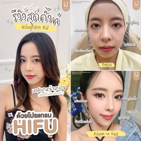 Hifu รัชดา ฉีดโบท็อกรัชดา  ฉีดโบท็อกอินทามระ  Botox ราคาถูก  โปรแกรมหน้าใส รัชดา  โปรแกรมหน้าใส อินทามระ  รักษาฝ้า รัชดา  รักษาฝ้า อินทามระ  รักษาสิว รัชดา  วิตามินผิว รัชดา  เสริมจมูก รัชดา 