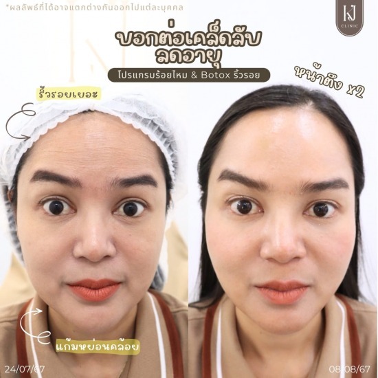 ฉีดโบท็อกอินทามระ ฉีดโบท็อกรัชดา  ฉีดโบท็อกอินทามระ  Botox ราคาถูก  โปรแกรมหน้าใส รัชดา  โปรแกรมหน้าใส อินทามระ  รักษาฝ้า รัชดา  รักษาฝ้า อินทามระ  รักษาสิว รัชดา  วิตามินผิว รัชดา  เสริมจมูก รัชดา 