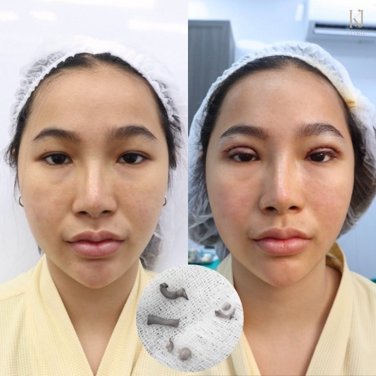 ทำตาสองชั้น รัชดา ฉีดโบท็อกรัชดา  ฉีดโบท็อกอินทามระ  Botox ราคาถูก  โปรแกรมหน้าใส รัชดา  โปรแกรมหน้าใส อินทามระ  รักษาฝ้า รัชดา  รักษาฝ้า อินทามระ  รักษาสิว รัชดา  วิตามินผิว รัชดา  เสริมจมูก รัชดา 