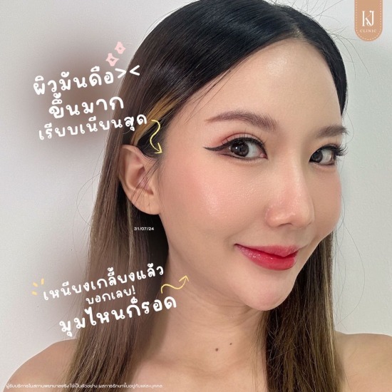 โปรแกรมหน้าใส อินทามระ ฉีดโบท็อกรัชดา  ฉีดโบท็อกอินทามระ  Botox ราคาถูก  โปรแกรมหน้าใส รัชดา  โปรแกรมหน้าใส อินทามระ  รักษาฝ้า รัชดา  รักษาฝ้า อินทามระ  รักษาสิว รัชดา  วิตามินผิว รัชดา  เสริมจมูก รัชดา 