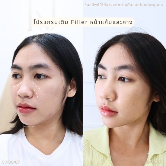 ฟิลเลอร์ รัชดา ฉีดโบท็อกรัชดา  ฉีดโบท็อกอินทามระ  Botox ราคาถูก  โปรแกรมหน้าใส รัชดา  โปรแกรมหน้าใส อินทามระ  รักษาฝ้า รัชดา  รักษาฝ้า อินทามระ  รักษาสิว รัชดา  วิตามินผิว รัชดา  เสริมจมูก รัชดา 