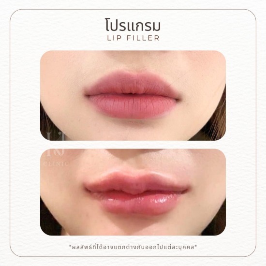 ฟิลเลอร์ปาก รัชดา ฉีดโบท็อกรัชดา  ฉีดโบท็อกอินทามระ  Botox ราคาถูก  โปรแกรมหน้าใส รัชดา  โปรแกรมหน้าใส อินทามระ  รักษาฝ้า รัชดา  รักษาฝ้า อินทามระ  รักษาสิว รัชดา  วิตามินผิว รัชดา  เสริมจมูก รัชดา 