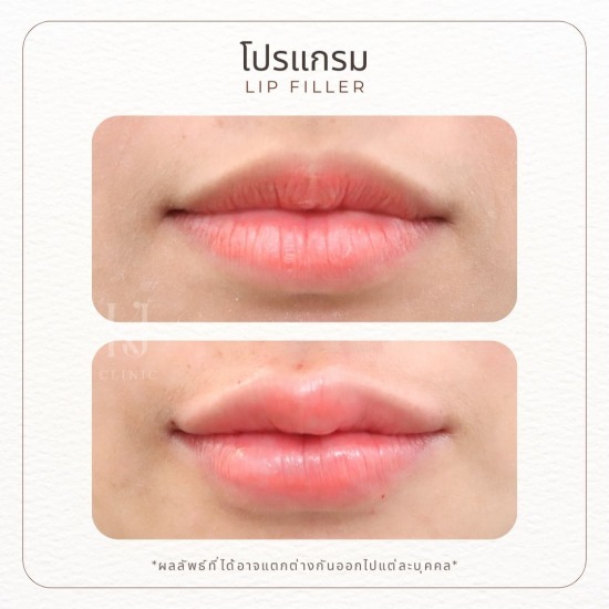 ฟิลเลอร์ปาก อินทามระ ฟิลเลอร์ปาก อินทามระ