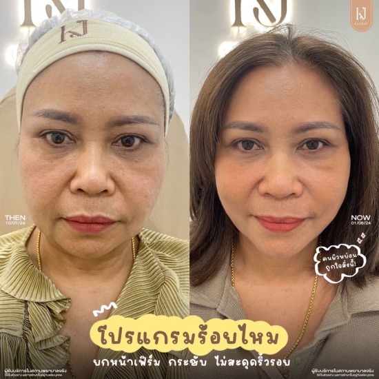 ร้อยไหม รัชดา ฉีดโบท็อกรัชดา  ฉีดโบท็อกอินทามระ  Botox ราคาถูก  โปรแกรมหน้าใส รัชดา  โปรแกรมหน้าใส อินทามระ  รักษาฝ้า รัชดา  รักษาฝ้า อินทามระ  รักษาสิว รัชดา  วิตามินผิว รัชดา  เสริมจมูก รัชดา 