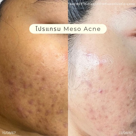 รักษาสิว รัชดา ฉีดโบท็อกรัชดา  ฉีดโบท็อกอินทามระ  Botox ราคาถูก  โปรแกรมหน้าใส รัชดา  โปรแกรมหน้าใส อินทามระ  รักษาฝ้า รัชดา  รักษาฝ้า อินทามระ  รักษาสิว รัชดา  วิตามินผิว รัชดา  เสริมจมูก รัชดา 