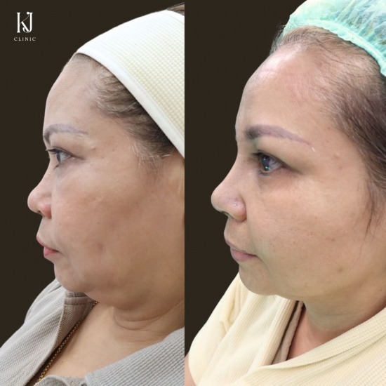 เสริมจมูกsemi open อินทามระ ฉีดโบท็อกรัชดา  ฉีดโบท็อกอินทามระ  Botox ราคาถูก  โปรแกรมหน้าใส รัชดา  โปรแกรมหน้าใส อินทามระ  รักษาฝ้า รัชดา  รักษาฝ้า อินทามระ  รักษาสิว รัชดา  วิตามินผิว รัชดา  เสริมจมูก รัชดา 