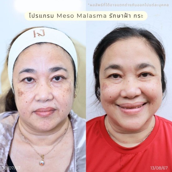 รักษาฝ้า รัชดา ฉีดโบท็อกรัชดา  ฉีดโบท็อกอินทามระ  Botox ราคาถูก  โปรแกรมหน้าใส รัชดา  โปรแกรมหน้าใส อินทามระ  รักษาฝ้า รัชดา  รักษาฝ้า อินทามระ  รักษาสิว รัชดา  วิตามินผิว รัชดา  เสริมจมูก รัชดา 