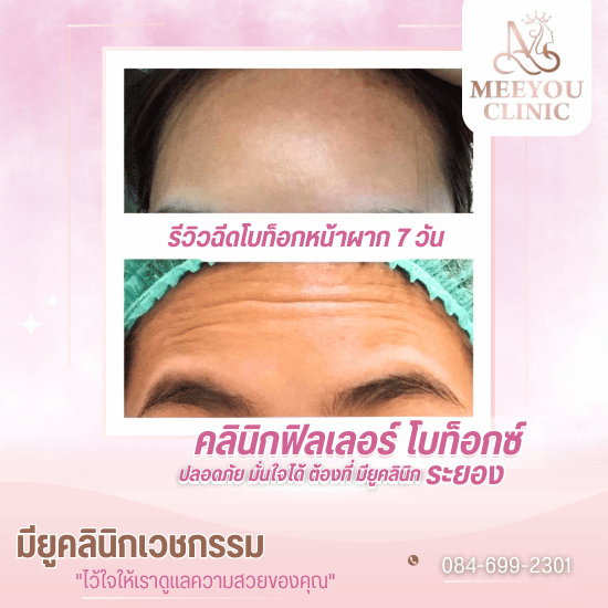 ฉีดฟิลเลอร์ โบท็อกซ์ ระยอง - คลินิกความงามระยอง - มียูคลินิก เวชกรรม