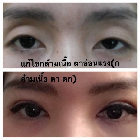 แก้ไขกล้ามเนื้อตาอ่อนแรง