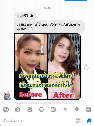 เสริมจมูกให้เหมาะกับรูปหน้า