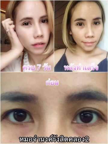 เสริมจมูกรูปหยดน้ำ