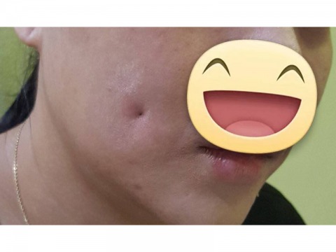 ทำลักยิ้มสวยๆ