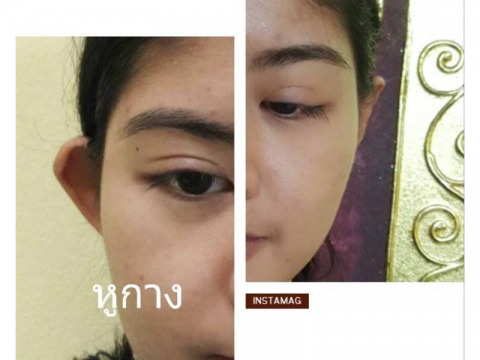 ศัลกรรมแก้ไขหูกาง