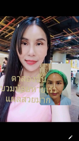 หมอจำนงค์ทำตา2ชั้น ราคาพิเศษ