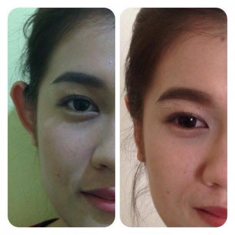 ศัลกรรมแก้ไขหูกาง