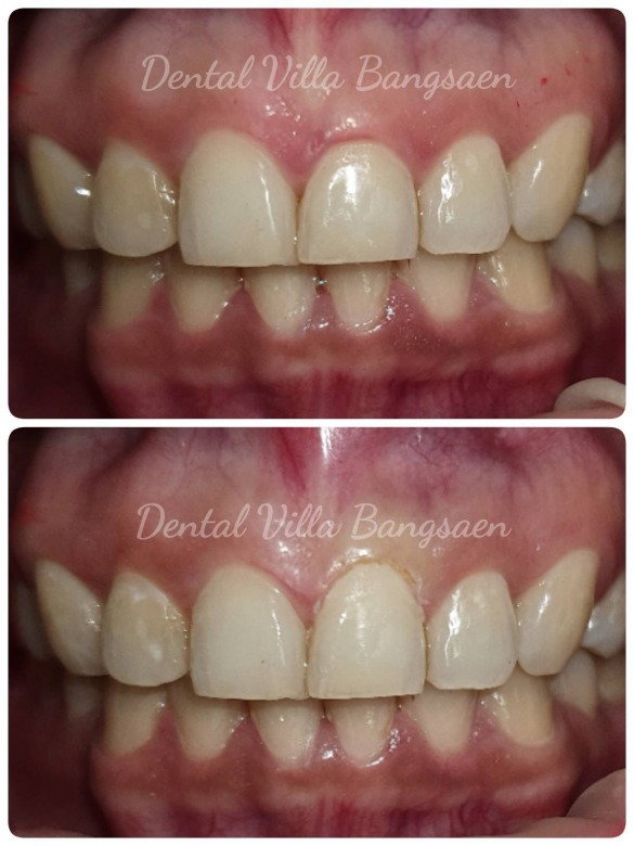 เลเซอร์ทางทันตกรรม  Laser Dentistry บางแสน